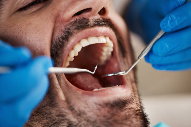 Best Emergency Tooth Extraction in Elmo, TX